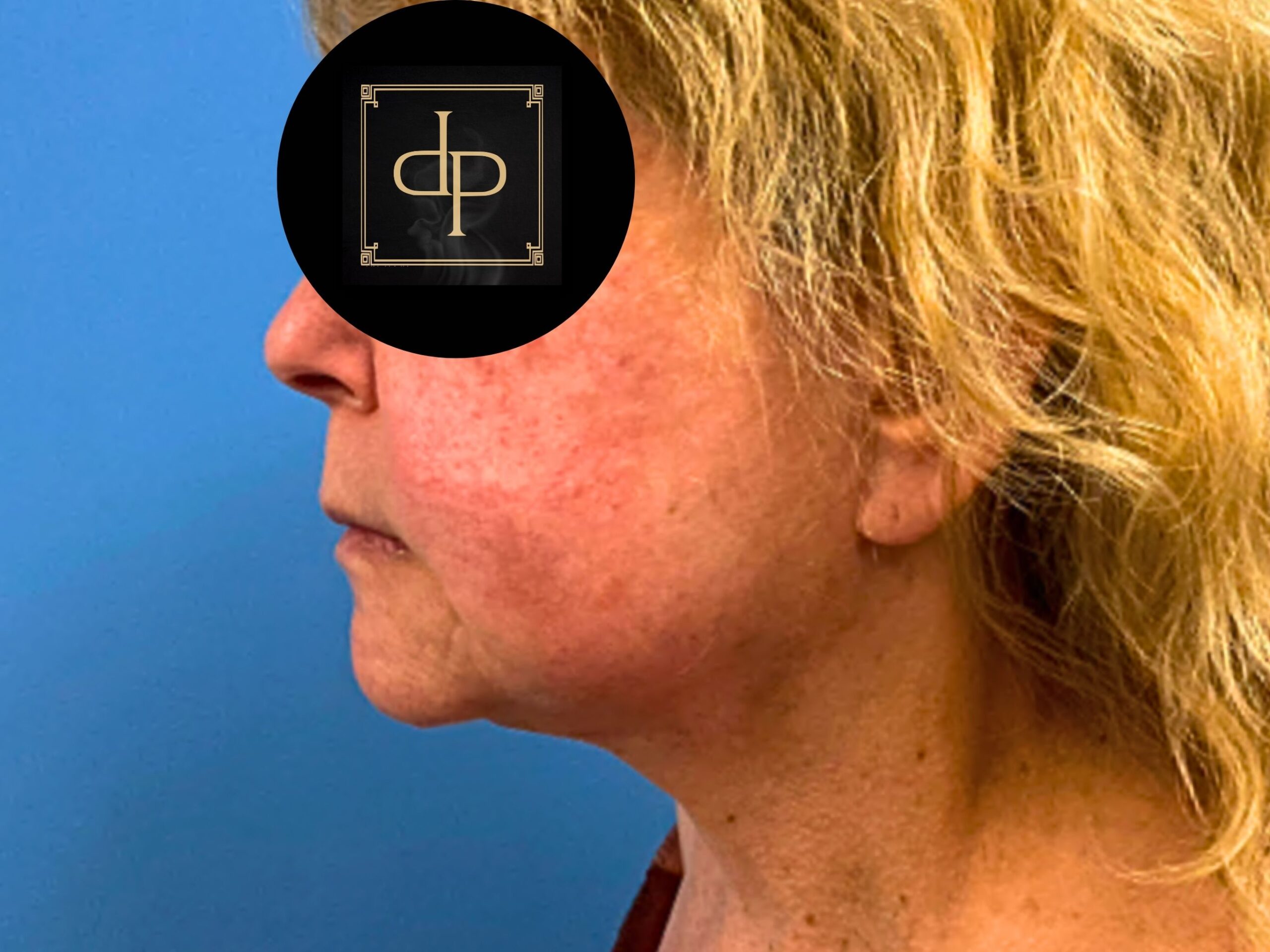 facelift-case--9596 | After Facelift