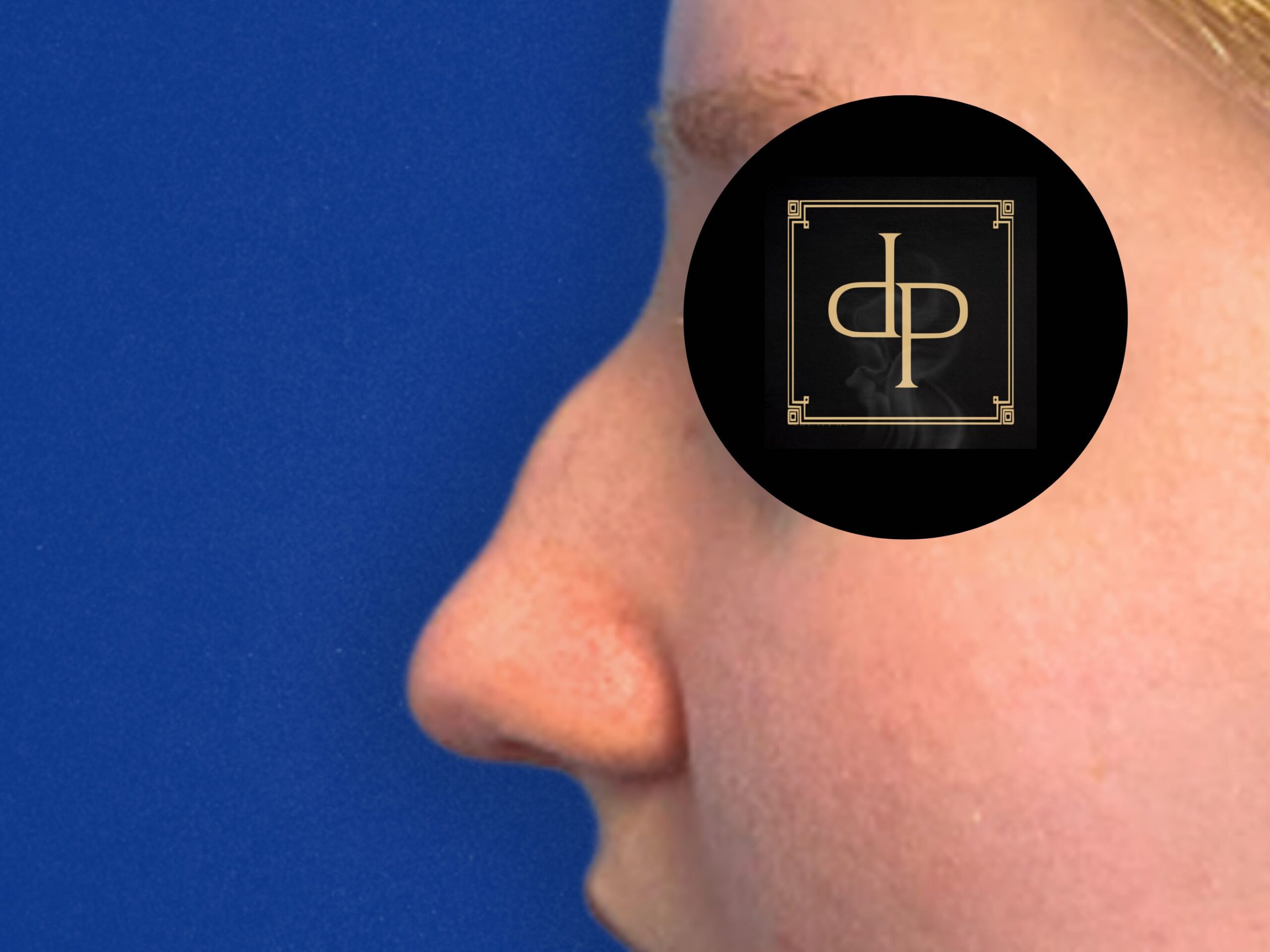 Rhinoplasty-Case--4839 | Before Rhinoplasty