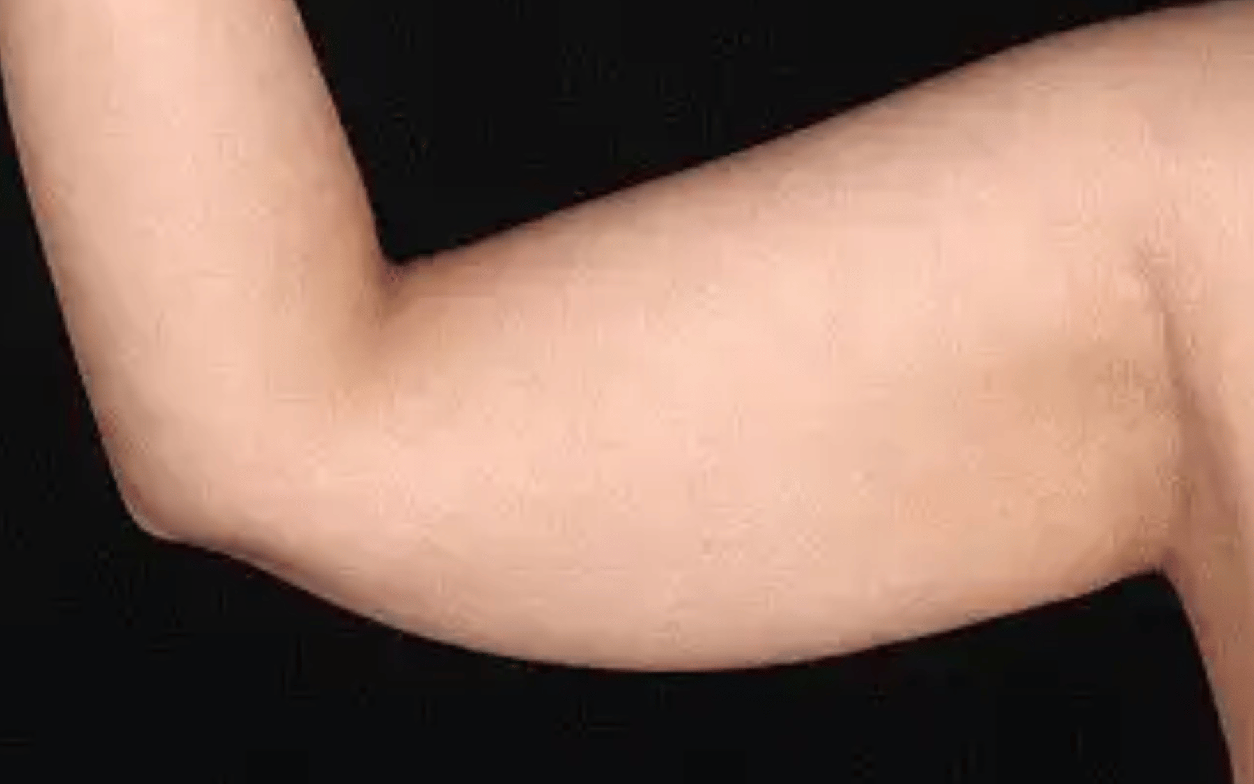 BodyTite--Case-Study-1568 | Before BodyTite