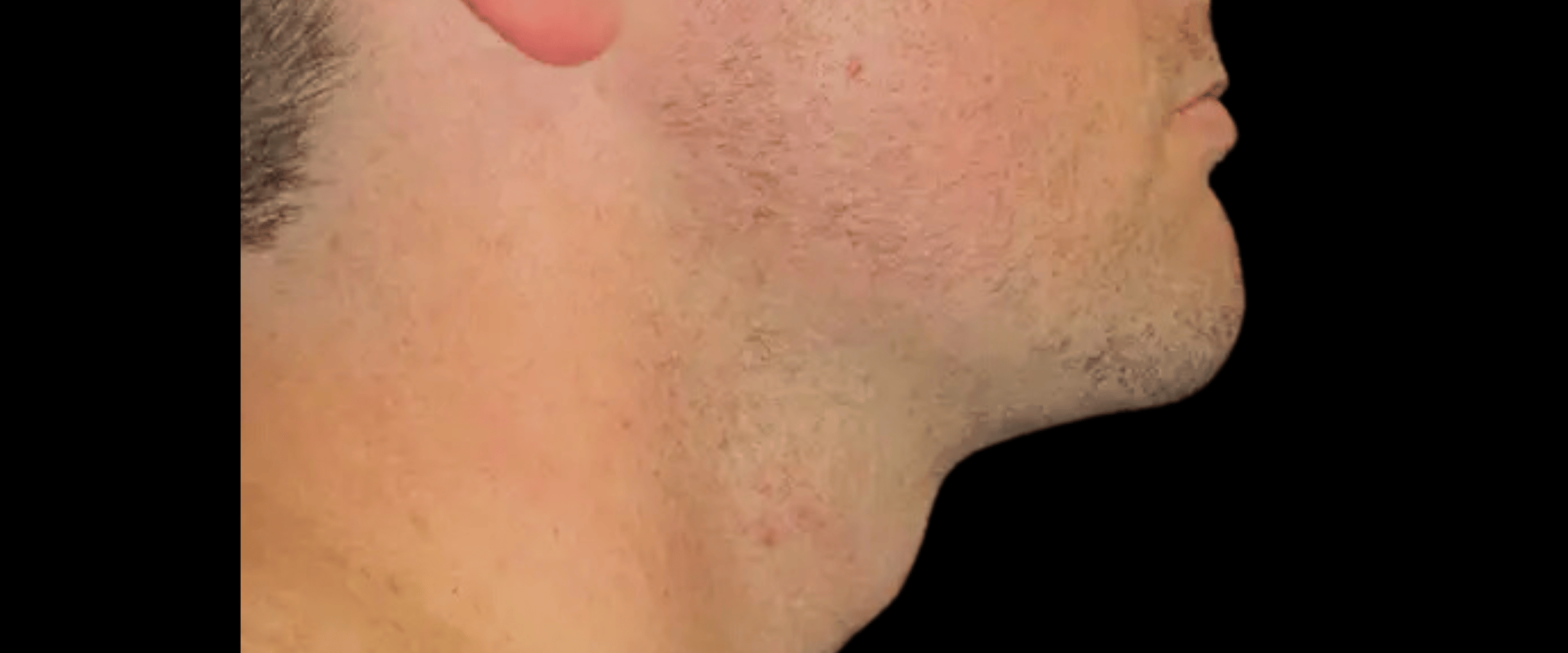 Facetite--Case-Study-7502 | After Face