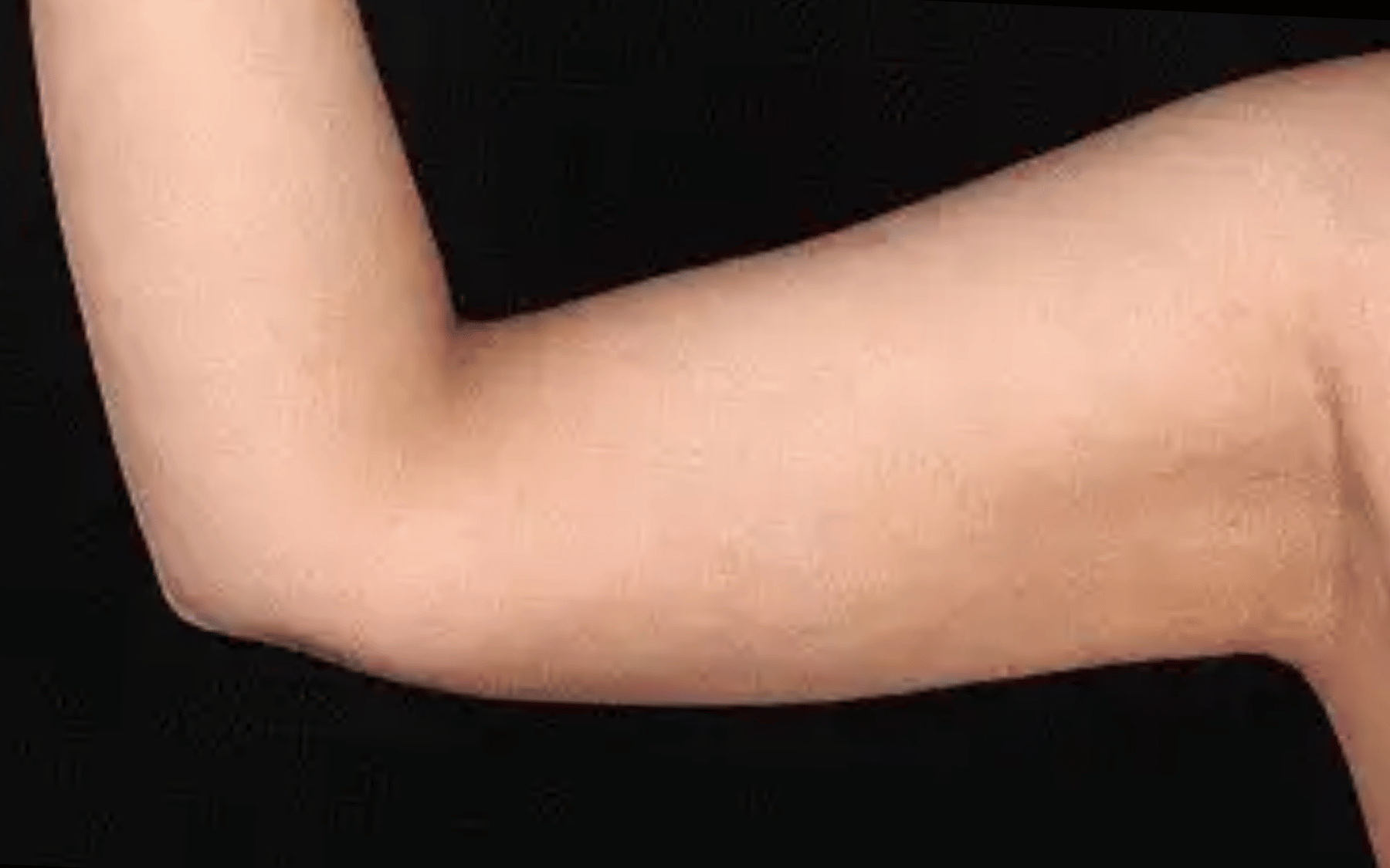 BodyTite--Case-Study-1568 | After BodyTite