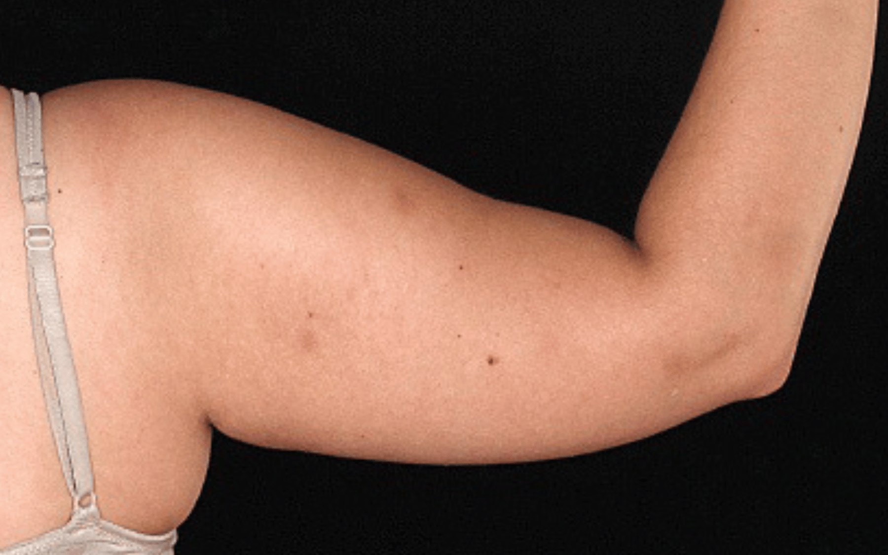 BodyTite--Case-Study-8375 | Before BodyTite