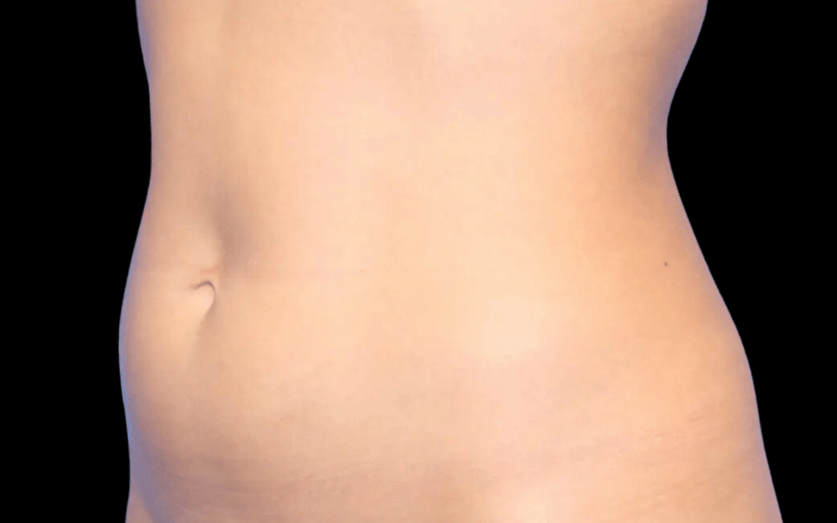 BodyTite--Case-Study-5284 | Before BodyTite