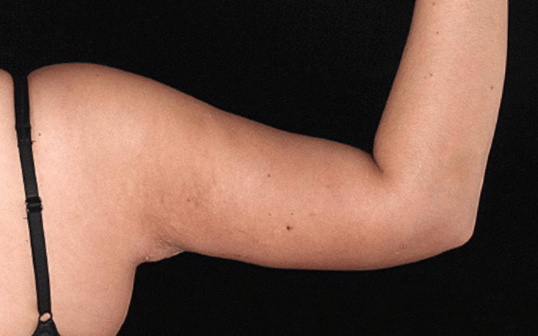 BodyTite--Case-Study-8375 | After BodyTite