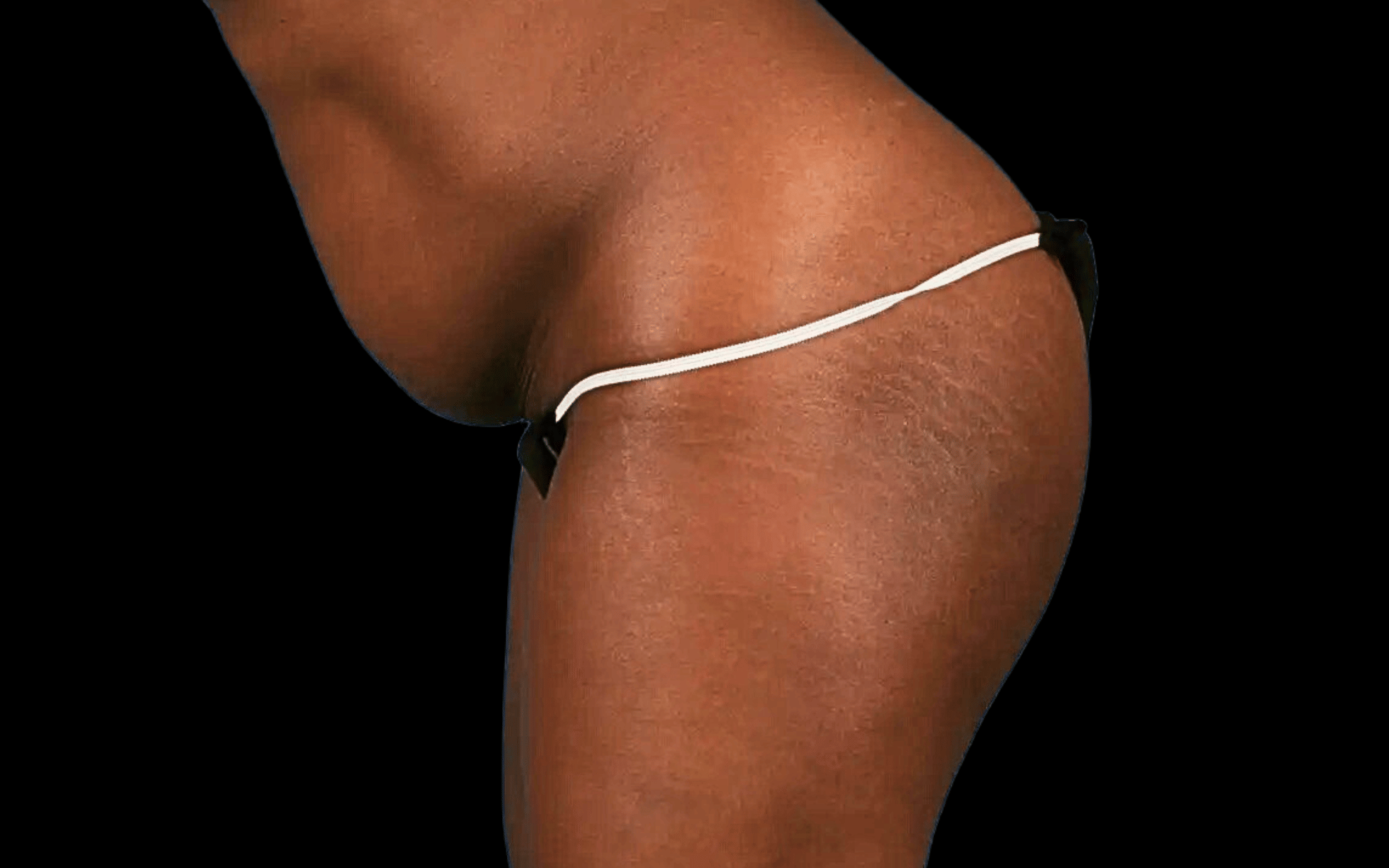 BodyTite--Case-Study-2641 | Before BodyTite