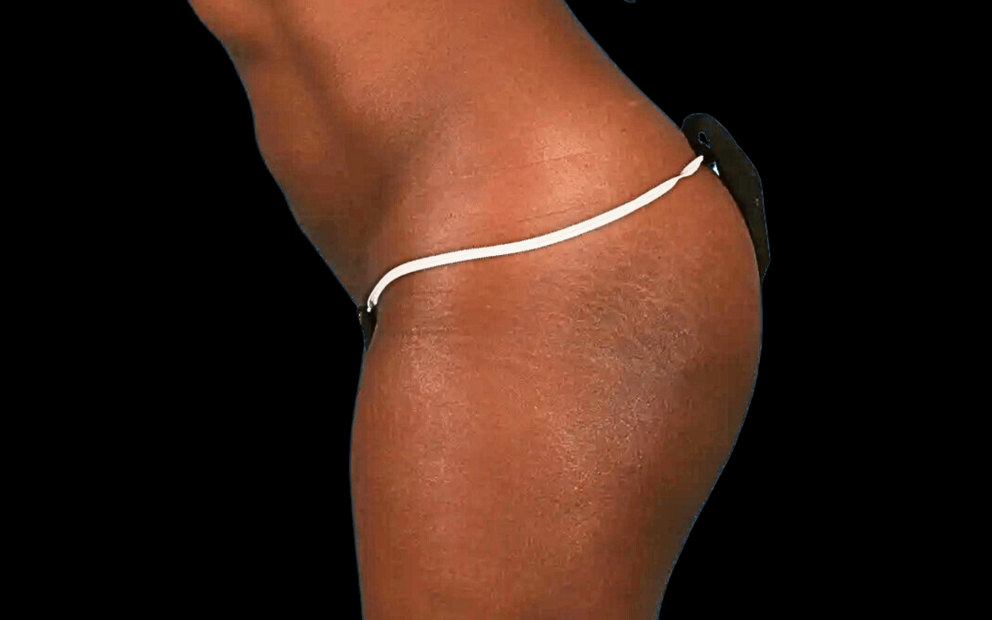 BodyTite--Case-Study-2641 | After BodyTite