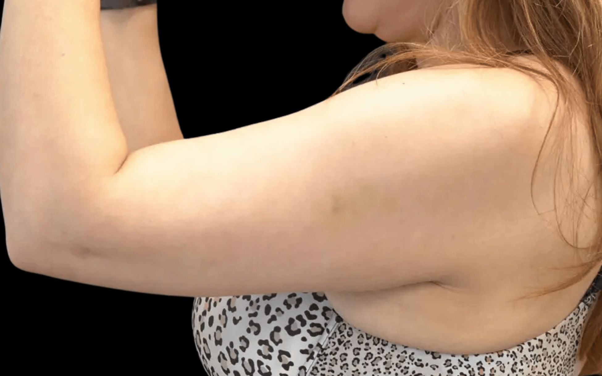 BodyTite--Case-Study-3716 | Before BodyTite