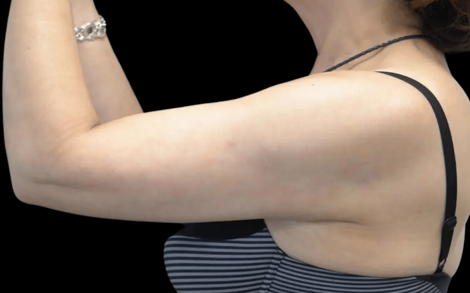 BodyTite--Case-Study-3716 | After BodyTite