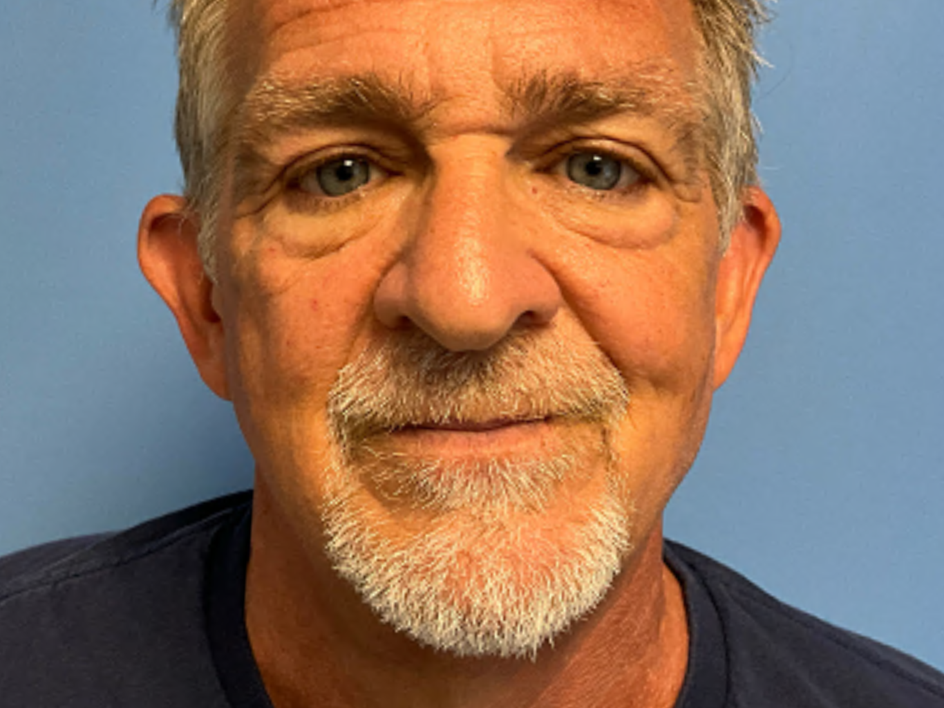 Neck-Lift--Case-3919 | Before Face