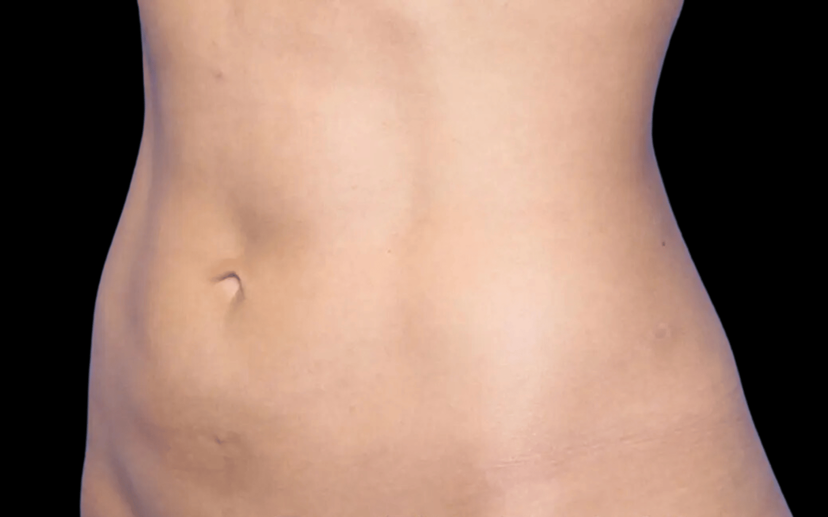 BodyTite--Case-Study-5284 | After BodyTite