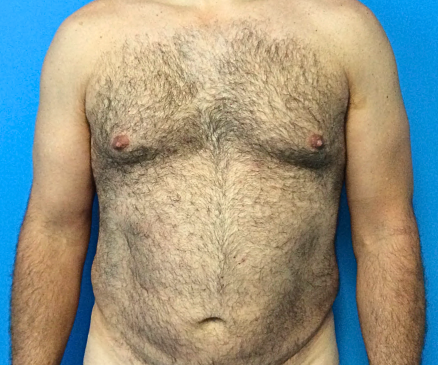 MALE-LIPOSUCTION | Before Liposuction