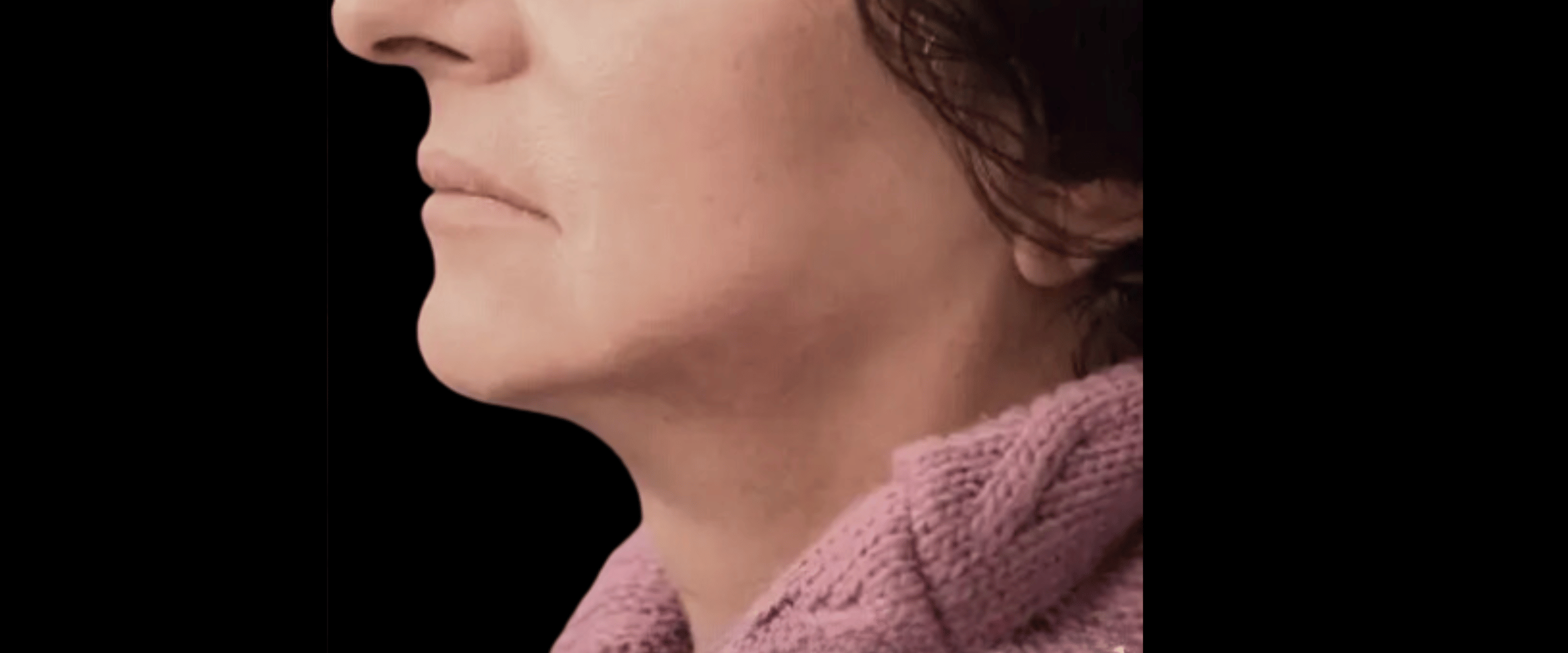 FaceTite--Case-Study-8195 | After Face