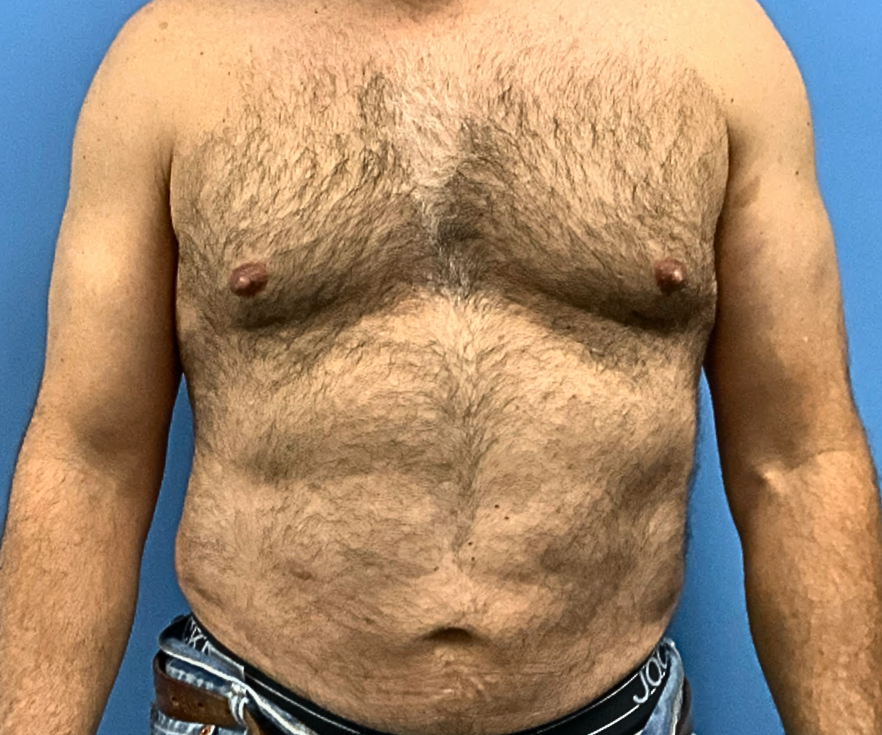 MALE-LIPOSUCTION | After Liposuction