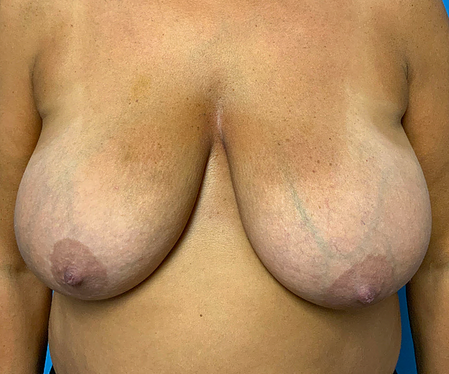 BREAST-REDUCTION--Case-Study-7315 | Before Breast Reduction With Lift