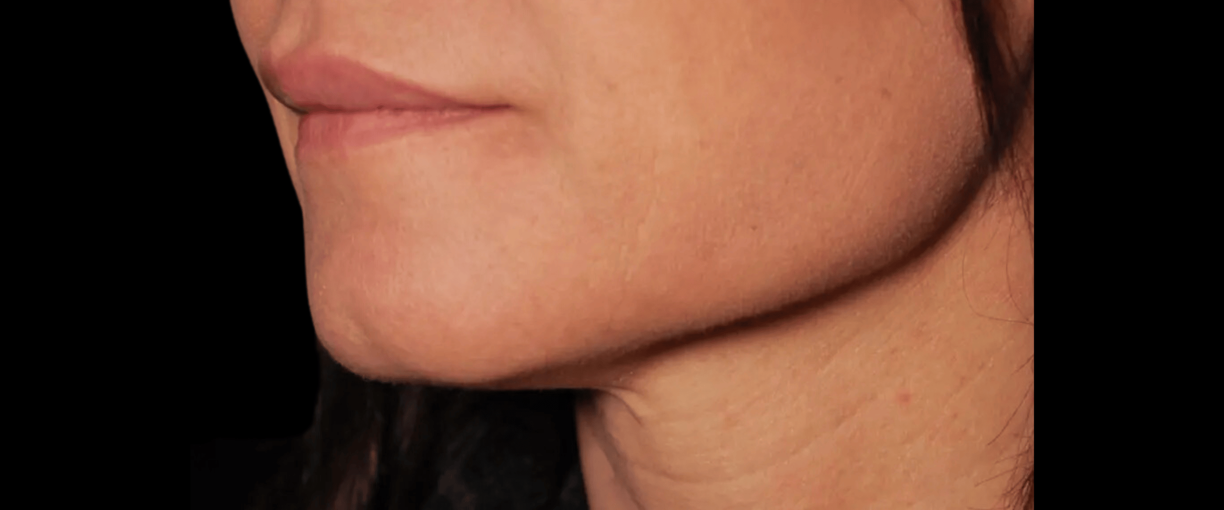 FaceTite--Case-Study-2607 | After Face