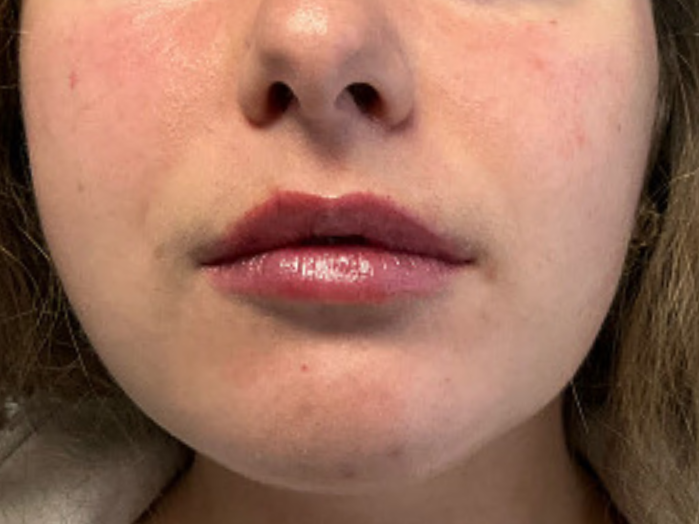 Lip-Filler--Case-Study-2748 | After Face