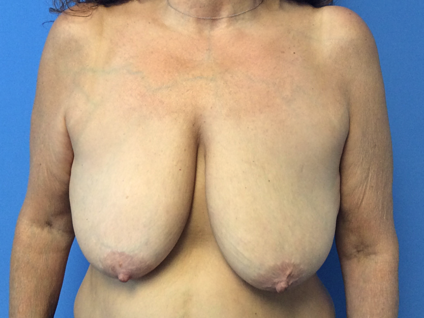 Breast-Reduction--Case-Study-9650 | Before Breast Reduction With Lift