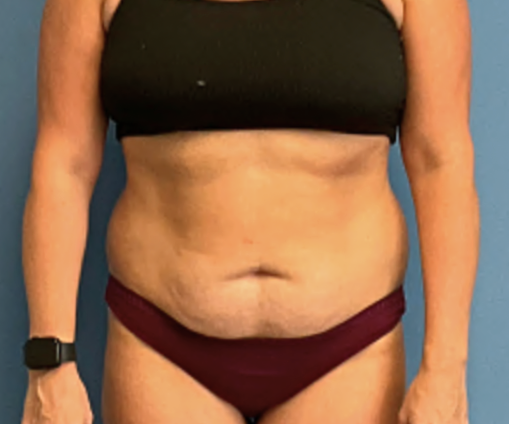 Tummy-Tuck-with-Liposuction--Case-Study-7304 | Before Liposuction