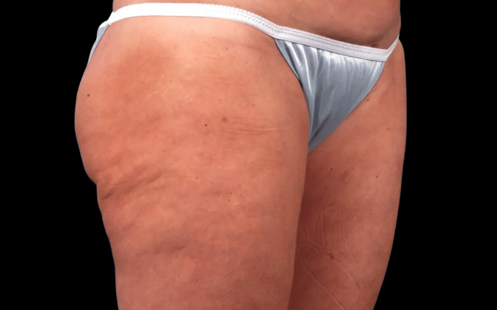 BodyTite--Case-Study-1475 | Before BodyTite