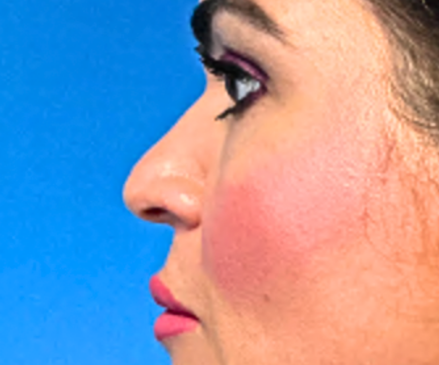 RHINOPLASTY--Case-Study-3168 | Before Face