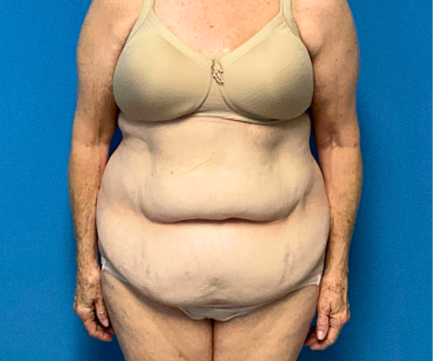 TUMMY-TUCK-WITH-LIPOSUCTION--Case-Study-4372 | Before Liposuction