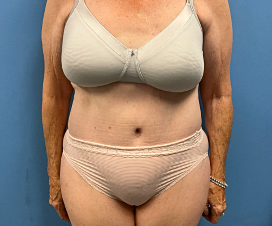 TUMMY-TUCK-WITH-LIPOSUCTION--Case-Study-4372 | After Liposuction