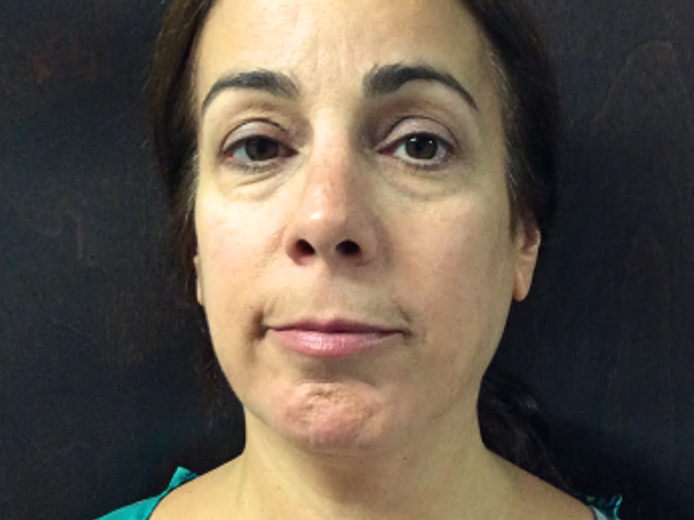 Eyelid-Lift-With-Chin-Liposuction | Before Face