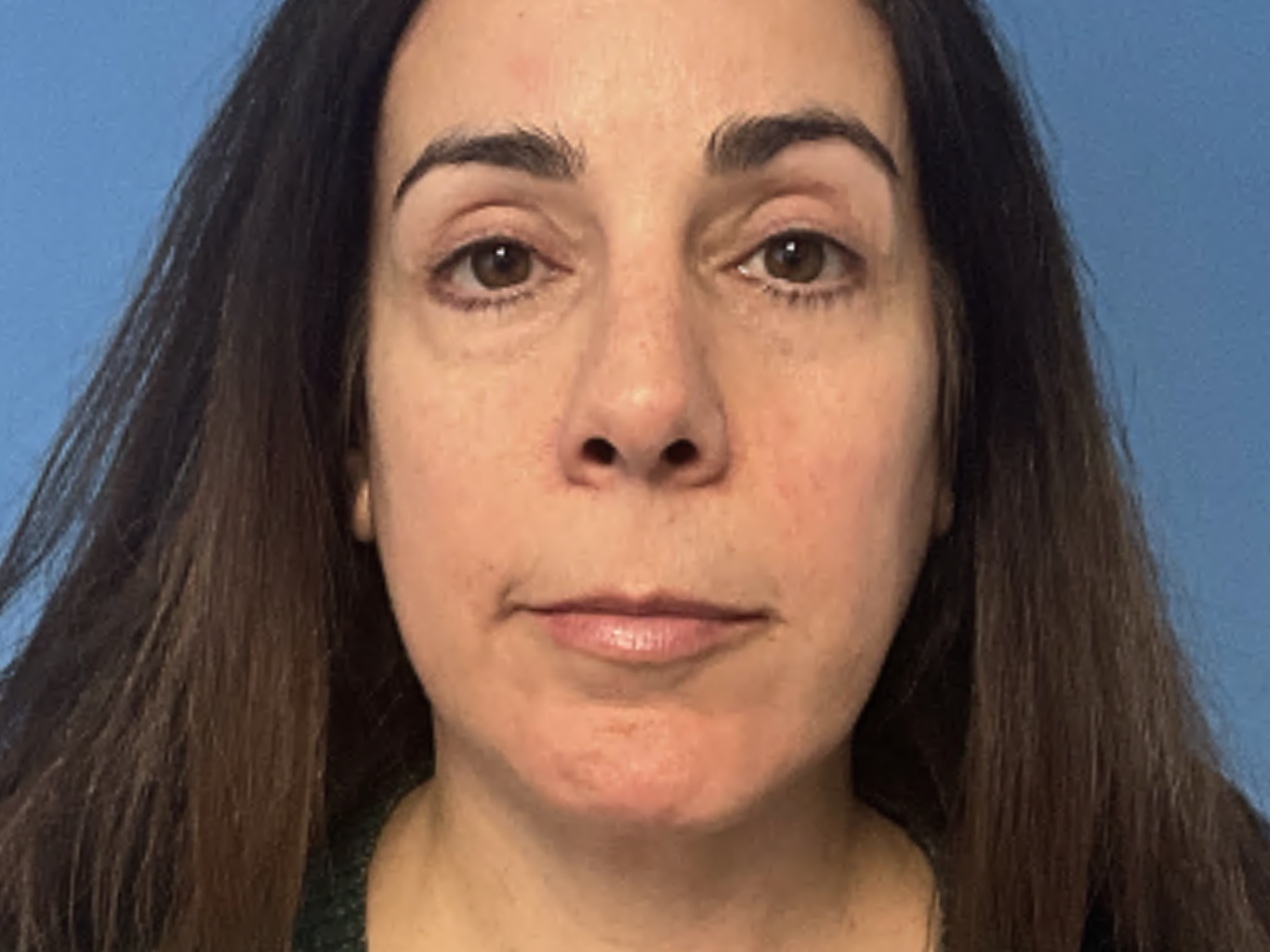 Eyelid-Lift-With-Chin-Liposuction | After Face