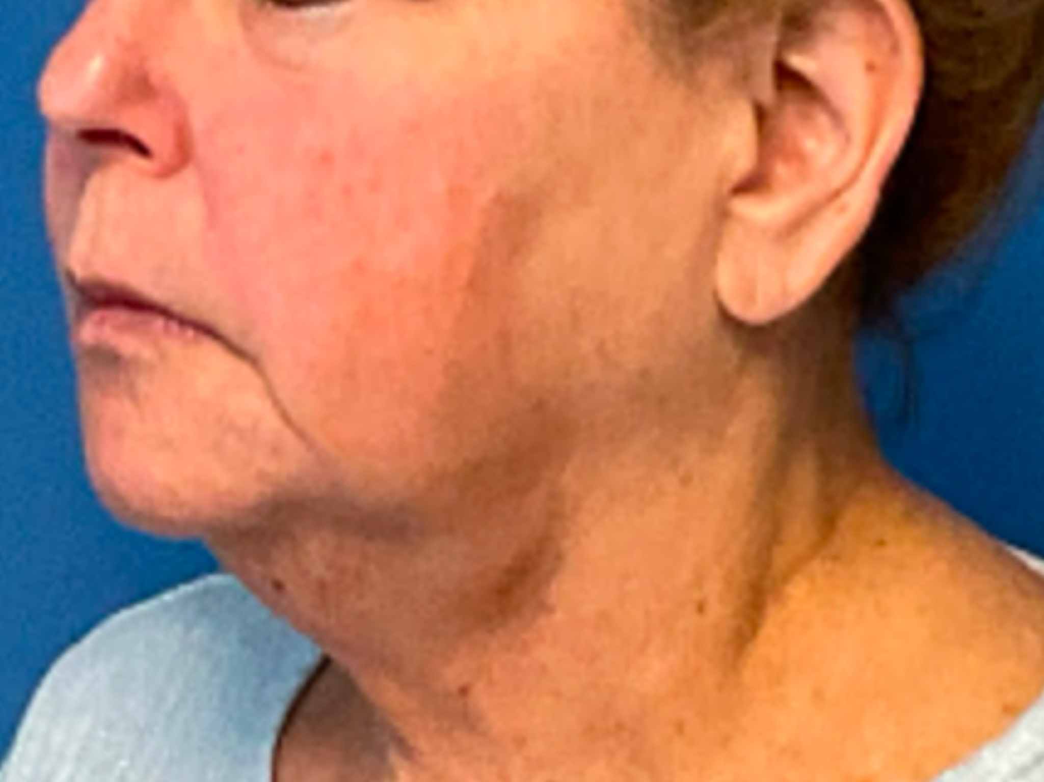 Neck-Lift--Case-10512 | Before Face