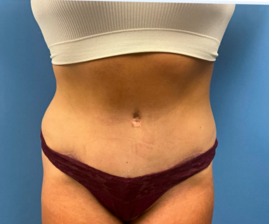 Tummy-Tuck-with-Liposuction--Case-Study-7304 | After Liposuction