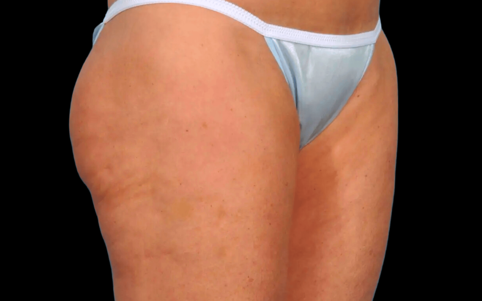 BodyTite--Case-Study-1475 | After BodyTite