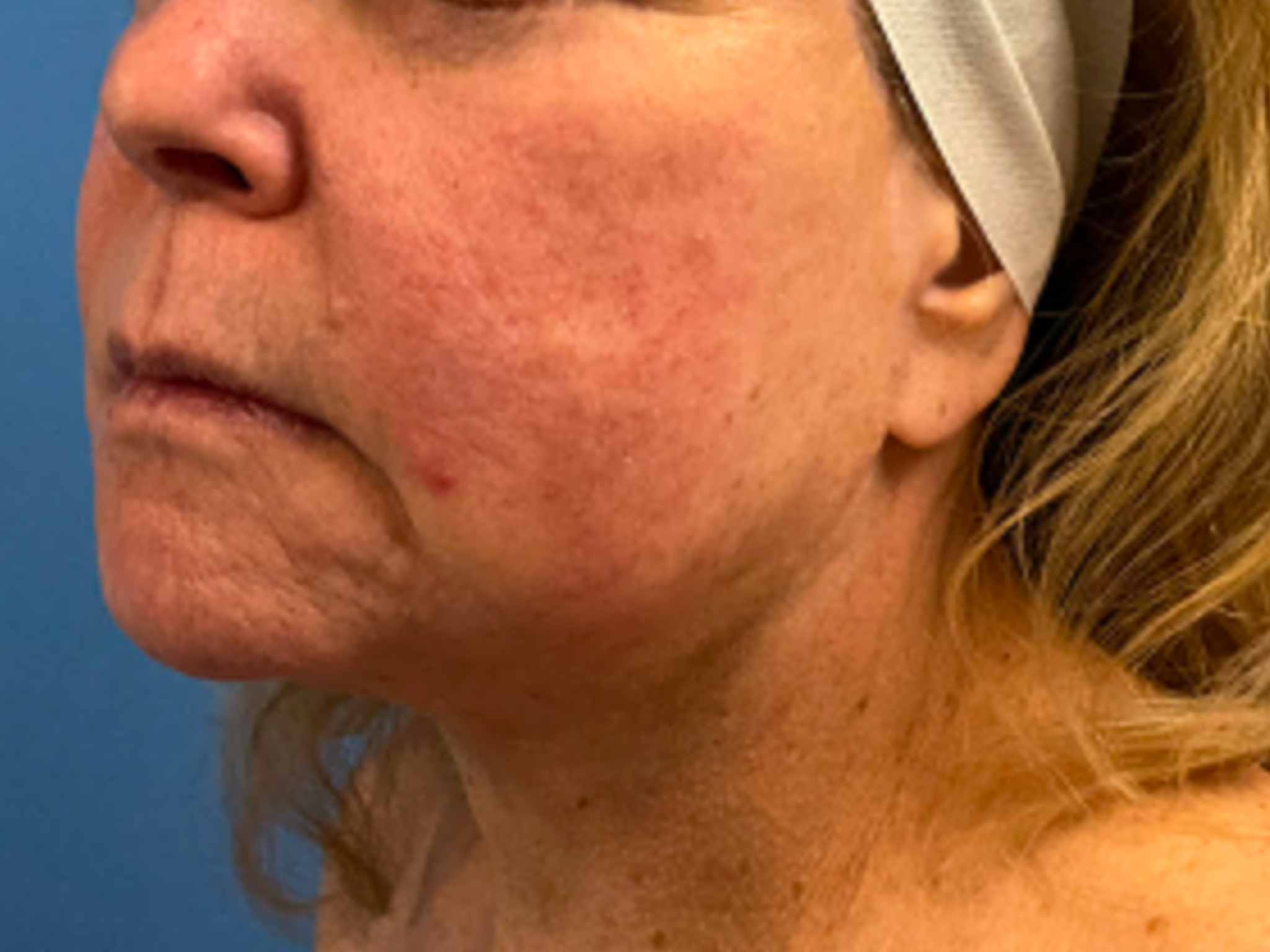 Neck-Lift--Case-10512 | After Face