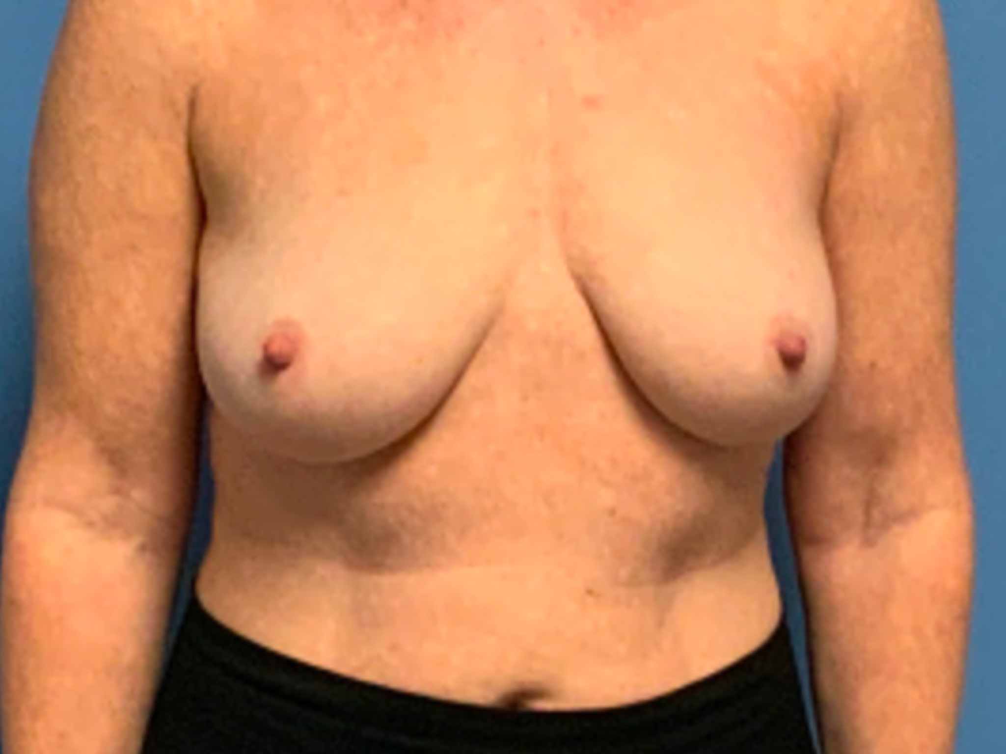 Breast-Lift-w--Augmentation | Before Breast Lift