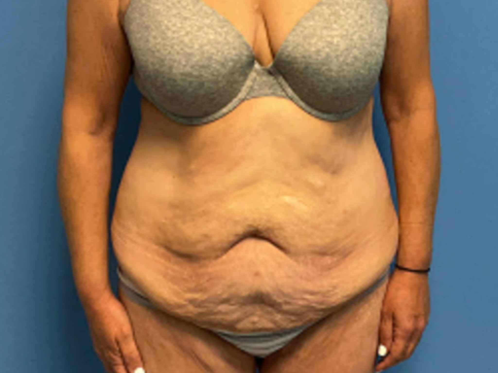 Fleur-de-Lis-abdominoplasty | Before Tummy Tuck