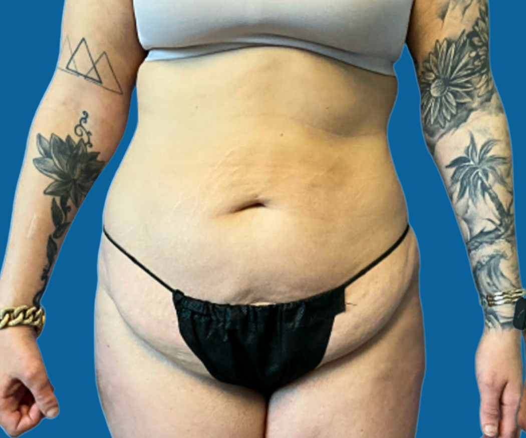 Tummy-Tuck-with-Liposuction--Case-Study-9584 | Before Liposuction