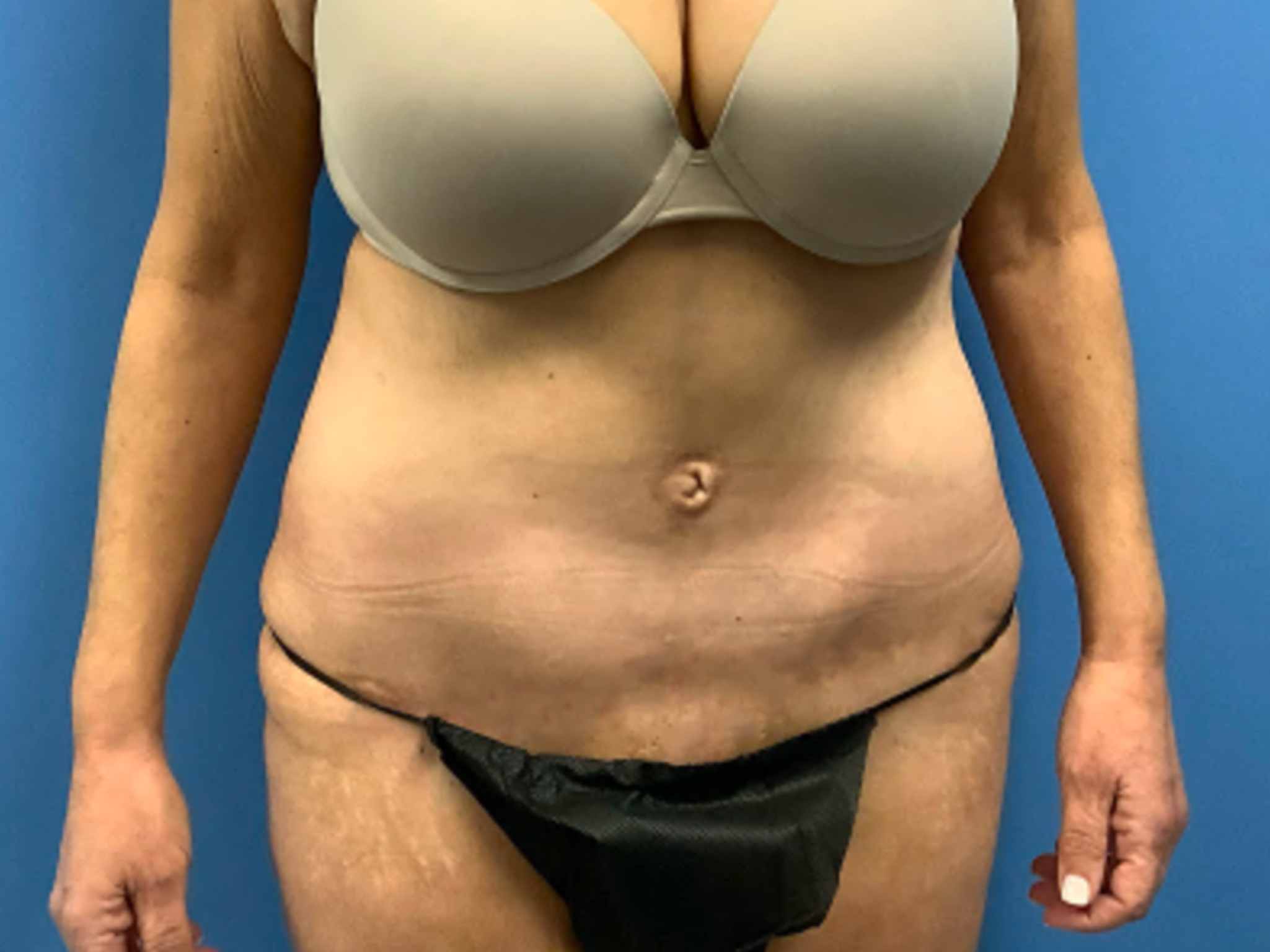 Fleur-de-Lis-abdominoplasty | After Tummy Tuck
