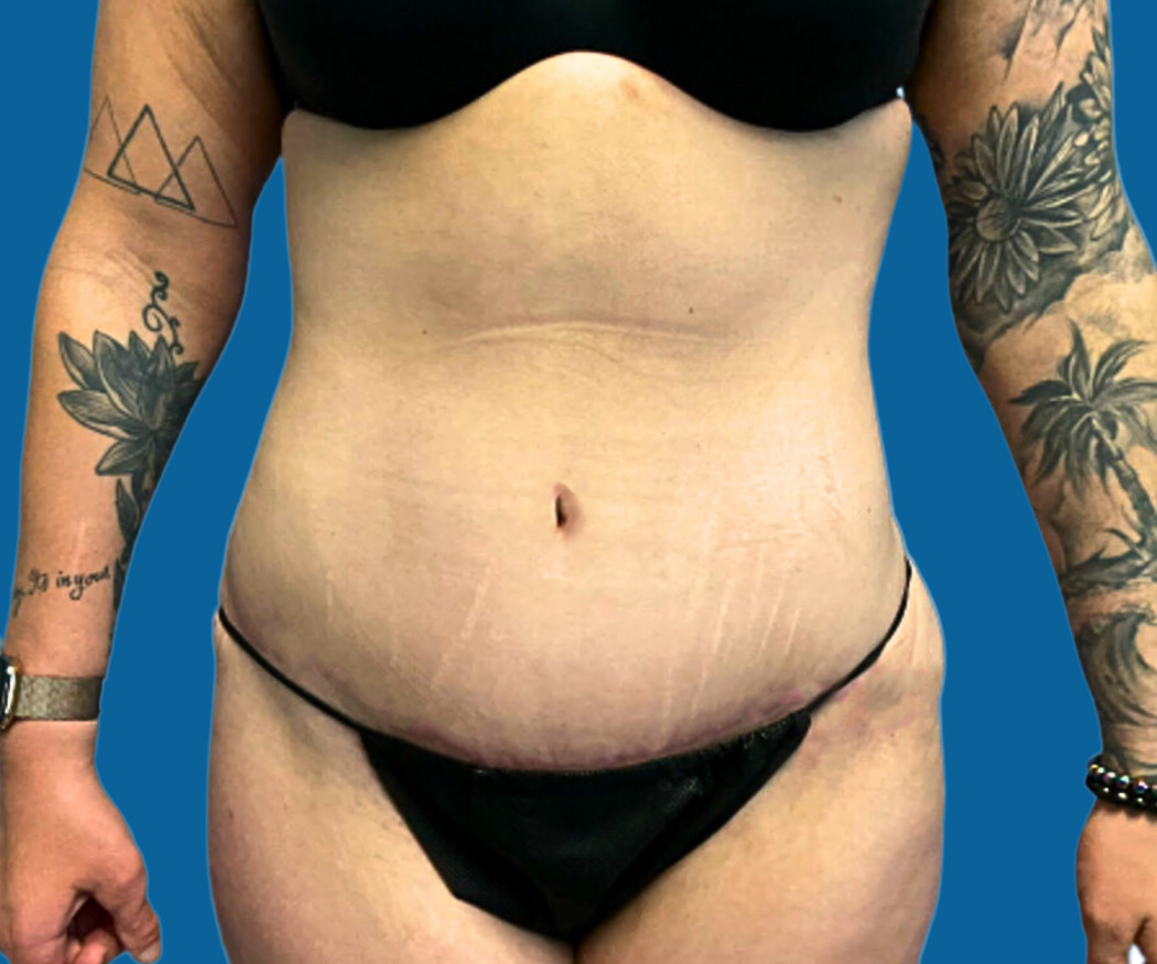 Tummy-Tuck-with-Liposuction--Case-Study-9584 | After Liposuction