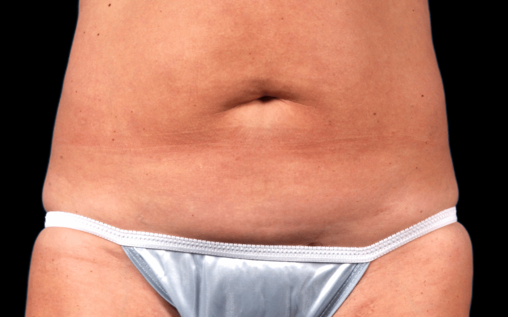BodyTite--Case-Study-8206 | Before BodyTite