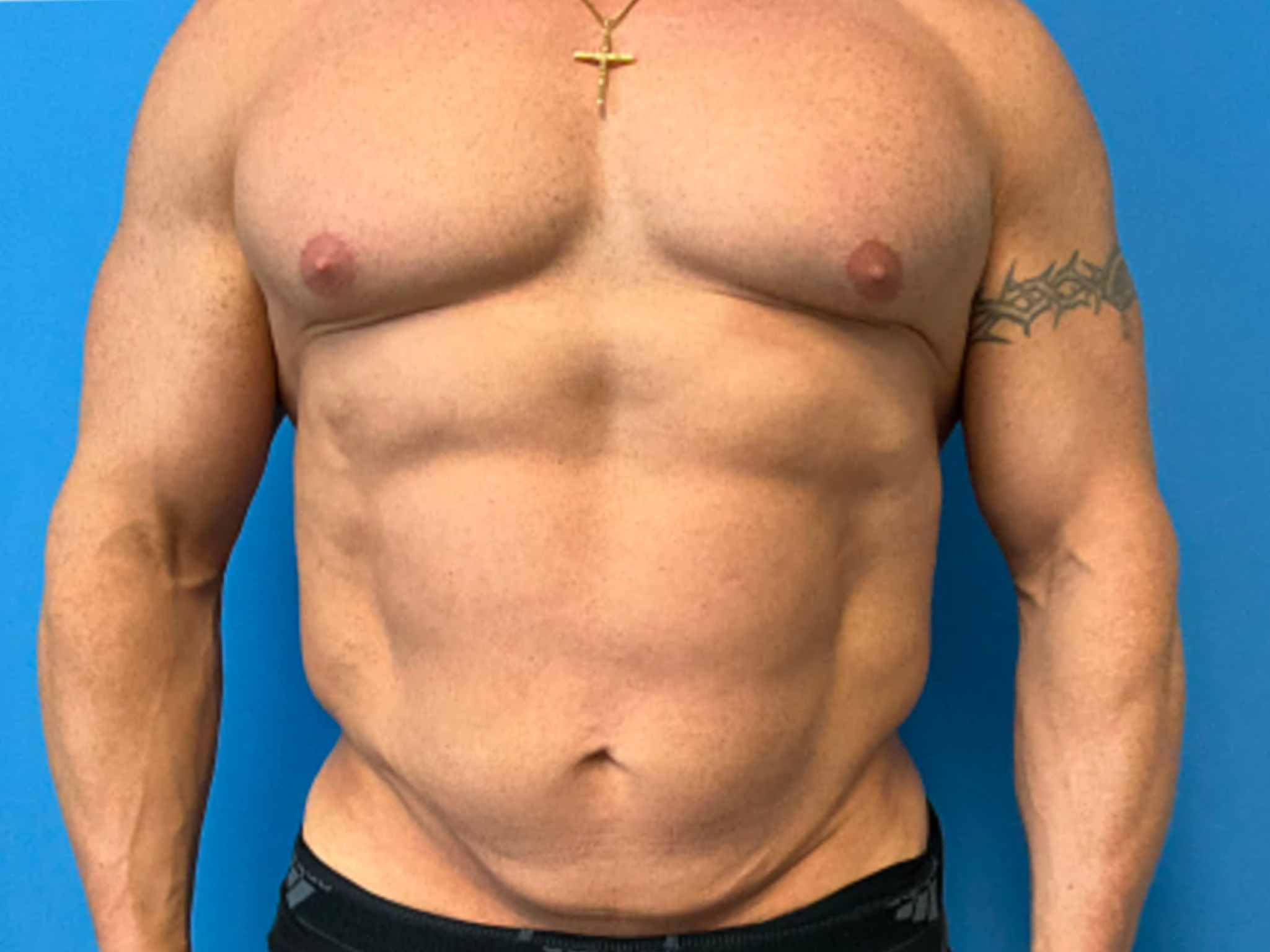 Tummy-Tuck--Case-5921 | After Body