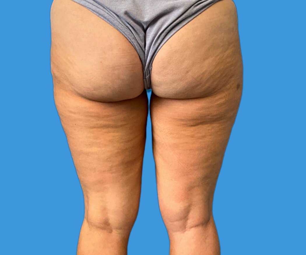 Bodytite--Case-Study-6930 | Before BodyTite