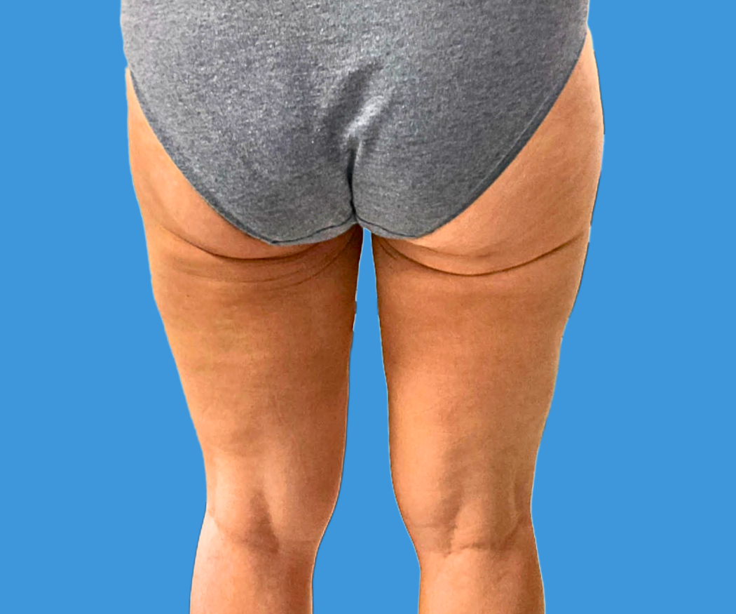 Bodytite--Case-Study-6930 | After BodyTite