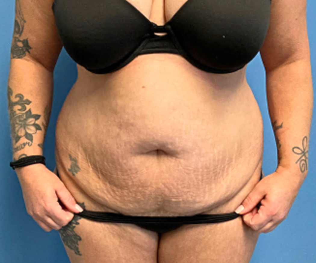 Tummy-Tuck-with-Liposuction--Case-Study-5197 | Before Liposuction