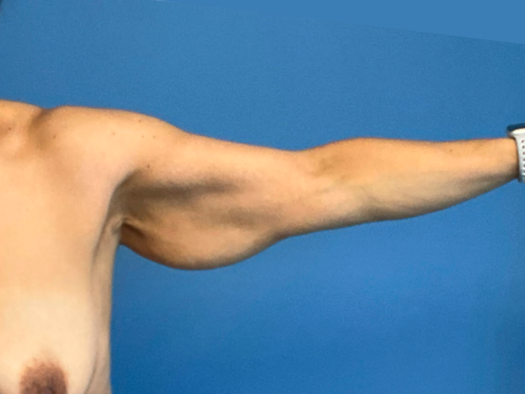 arm-lift--case-3009 | Before Arm Lift