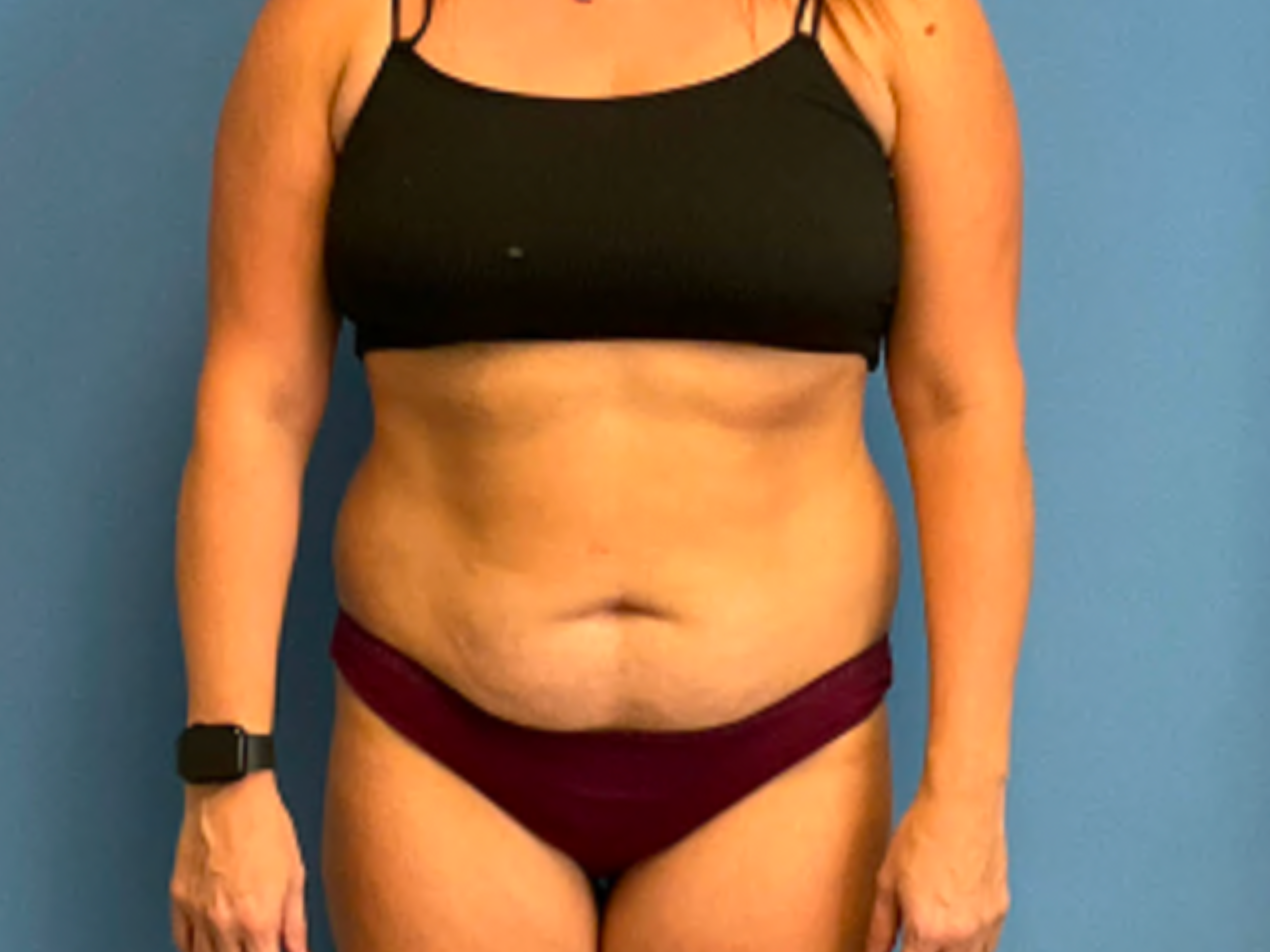 tummy-tuck-with-liposuction--case-1536 | Before Body