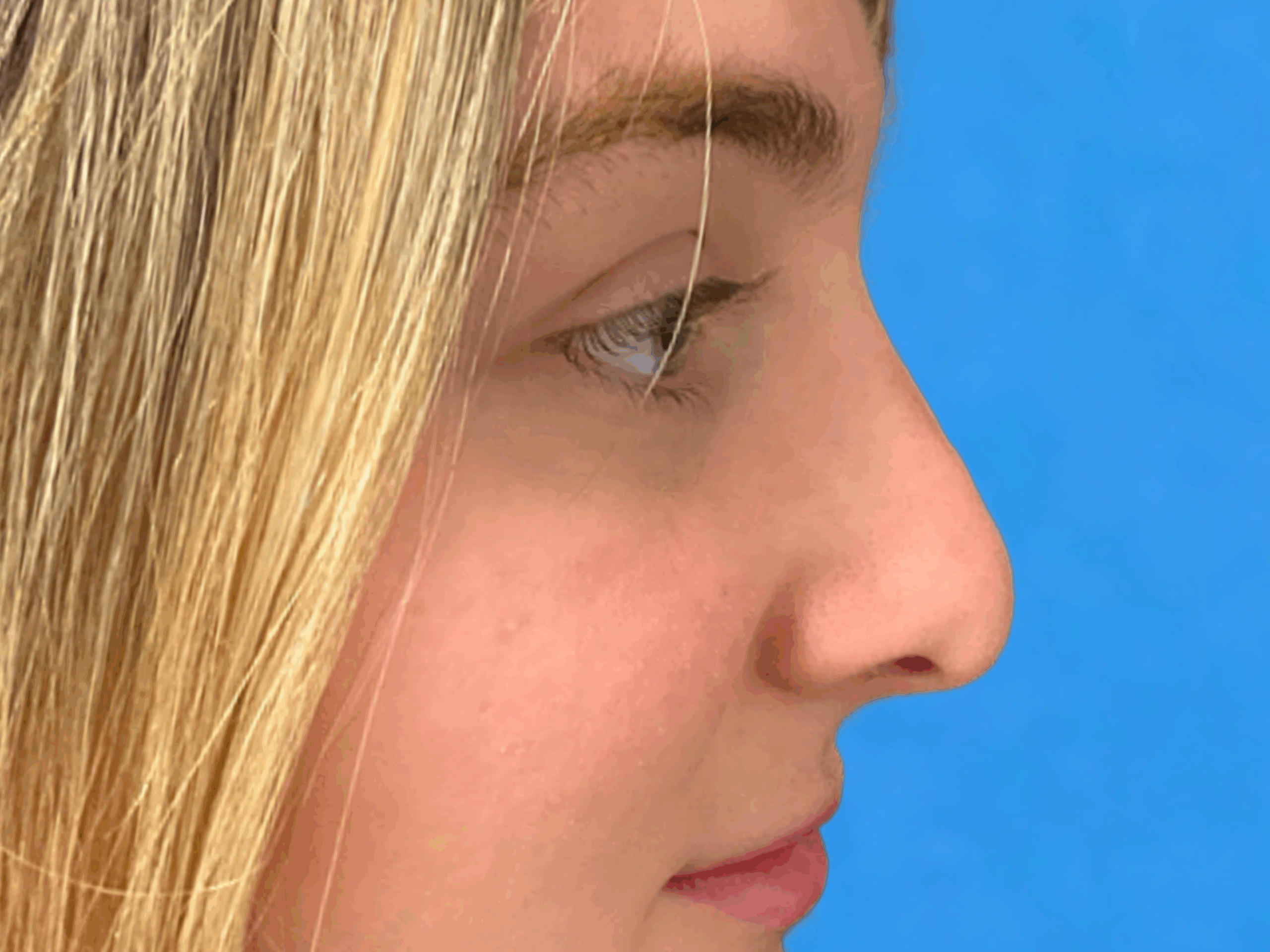 rhinoplasty-case-4567 | After Rhinoplasty