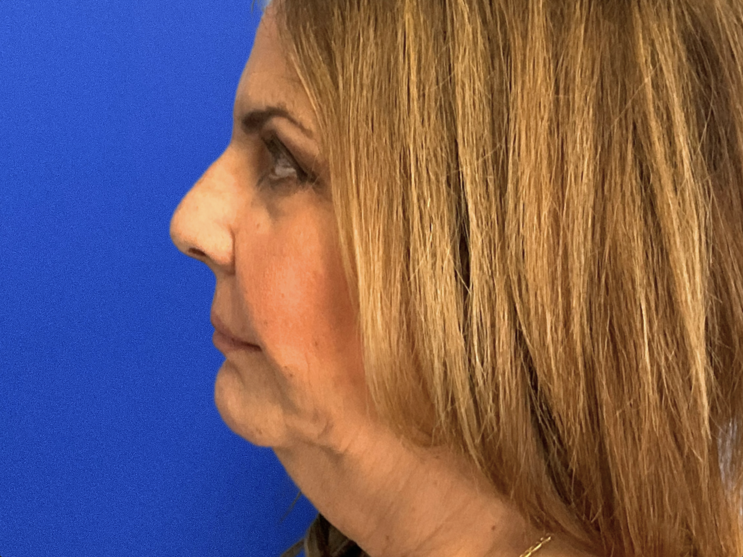 Facelift-Case--4879 | Before Facelift