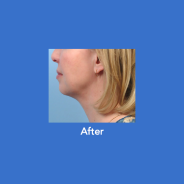 After Image