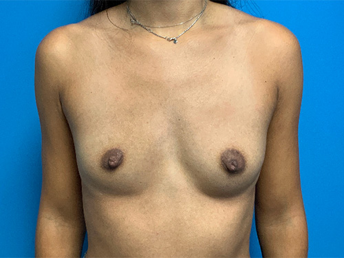 Breast-Augmentation--Case-Study-4820 | Before Breast