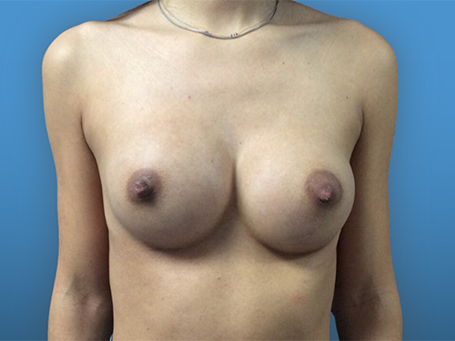 Breast-Augmentation--Case-Study-4820 | After Breast