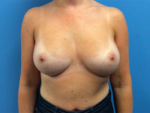 Breast-Augmentation--Case-Study-2358 | After Breast
